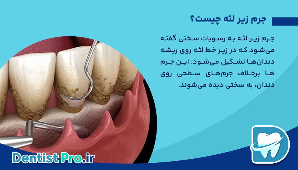 جرم زیر لثه چگونه ایجاد می شود؟