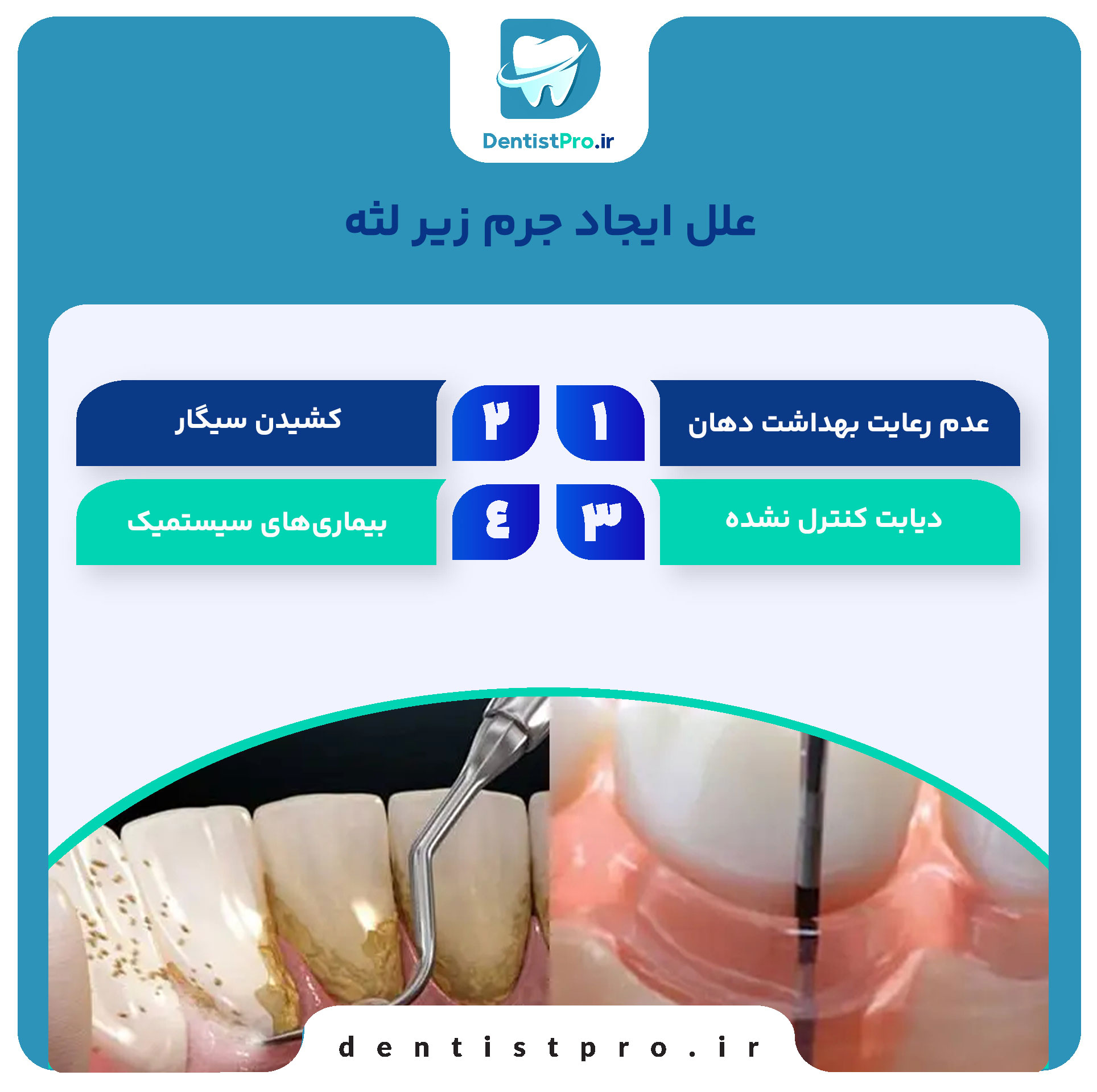 جرم زیر لثه چگونه ایجاد می شود؟