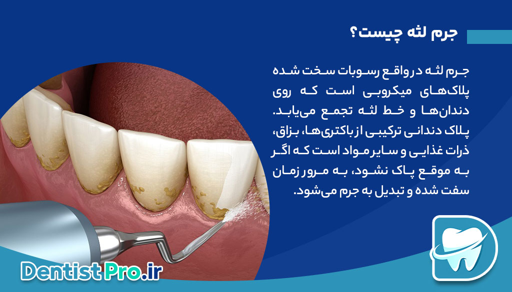 جرم لثه؛ پیشگیری، علائم و راه‌های درمان