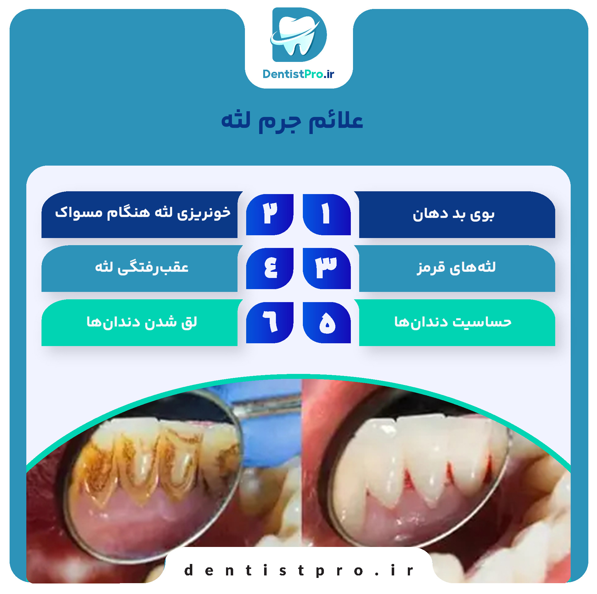 جرم لثه؛ پیشگیری، علائم و راه‌های درمان