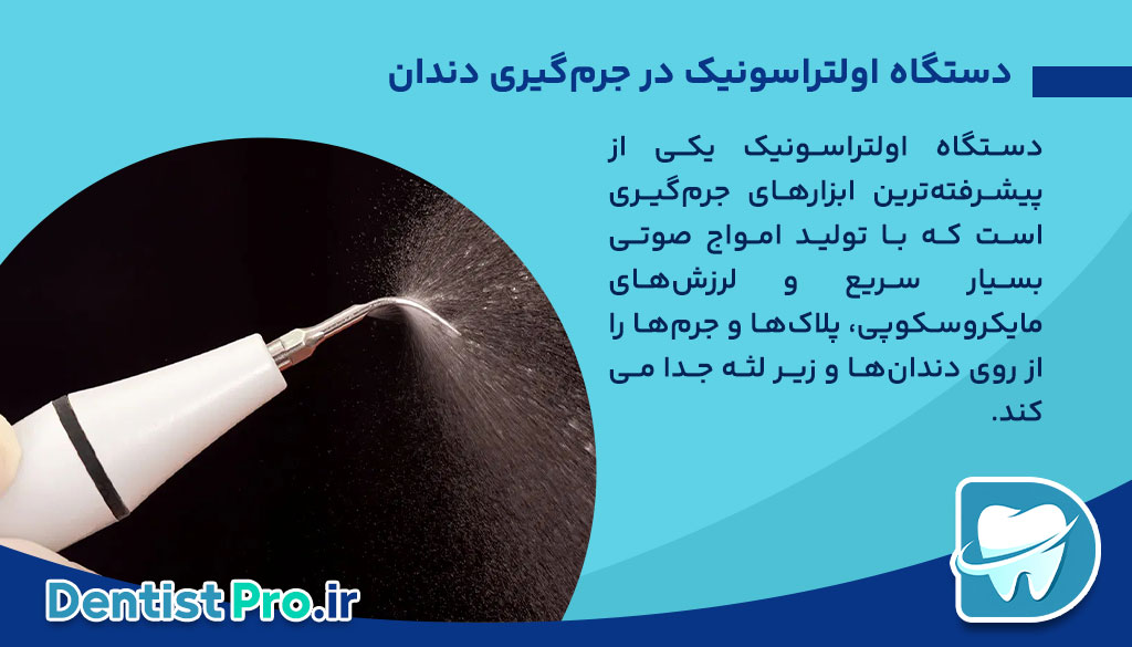 جرم گیری عمیق دندان با دستگاه اولتراسونیک: راهنمای جامع