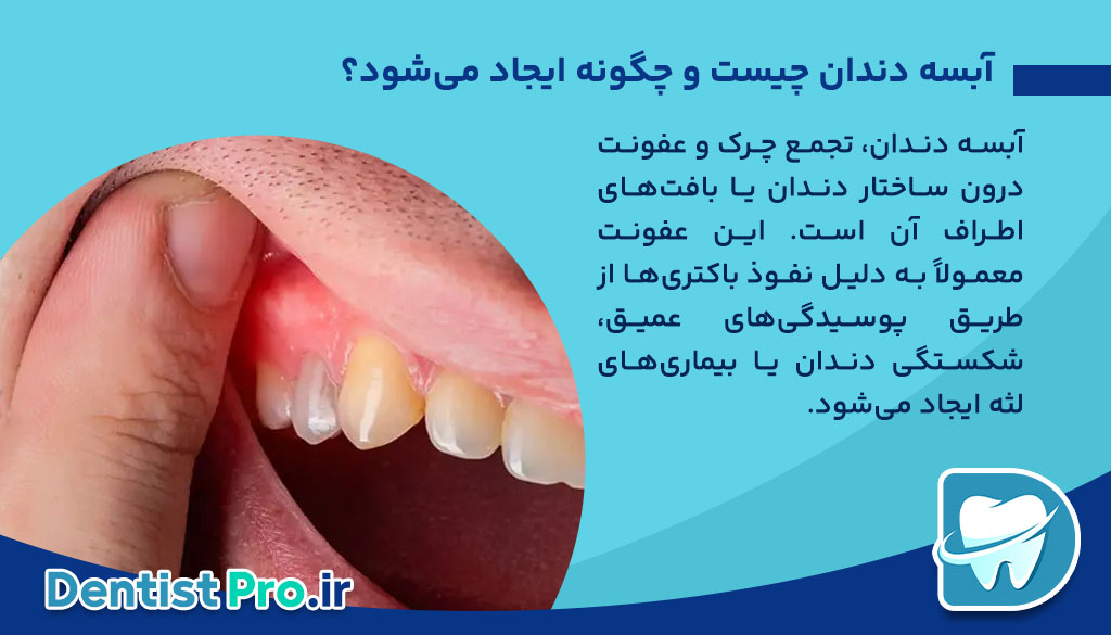 درمان آبسه دندان بدون جراحی: راهکارهای موثر و کم تهاجمی 26 درمان آبسه دندان بدون جراحی: راهکارهای موثر و کم تهاجمی