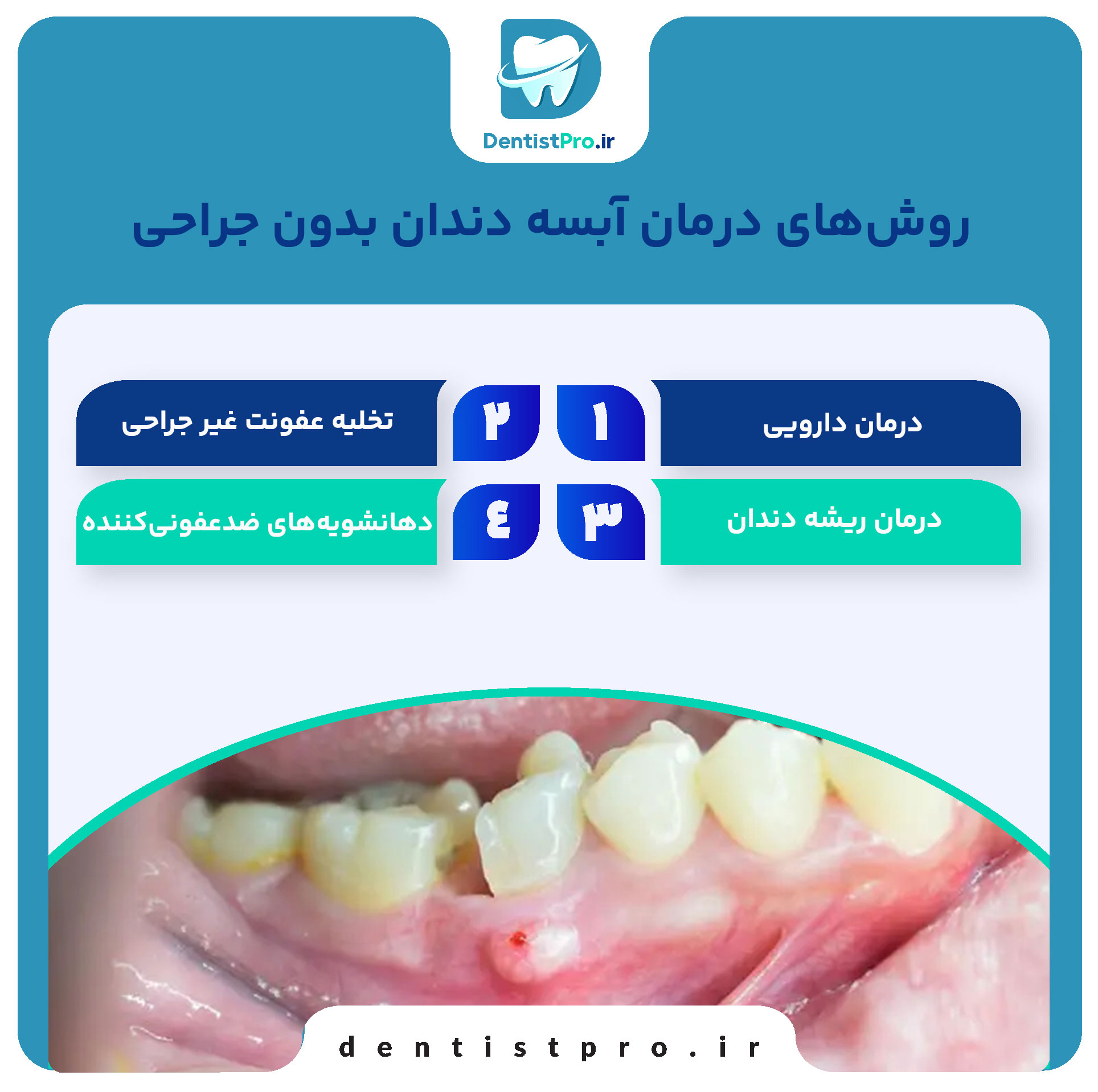 درمان آبسه دندان بدون جراحی: راهکارهای موثر و کم تهاجمی 27 درمان آبسه دندان بدون جراحی: راهکارهای موثر و کم تهاجمی