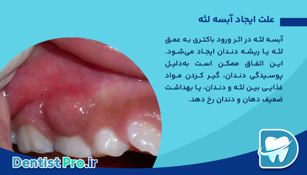 درمان آبسه لثه بدون آنتی بیوتیک