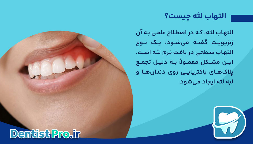 درمان التهاب لثه با لیزر: راهکاری نوین، مؤثر و بدون درد