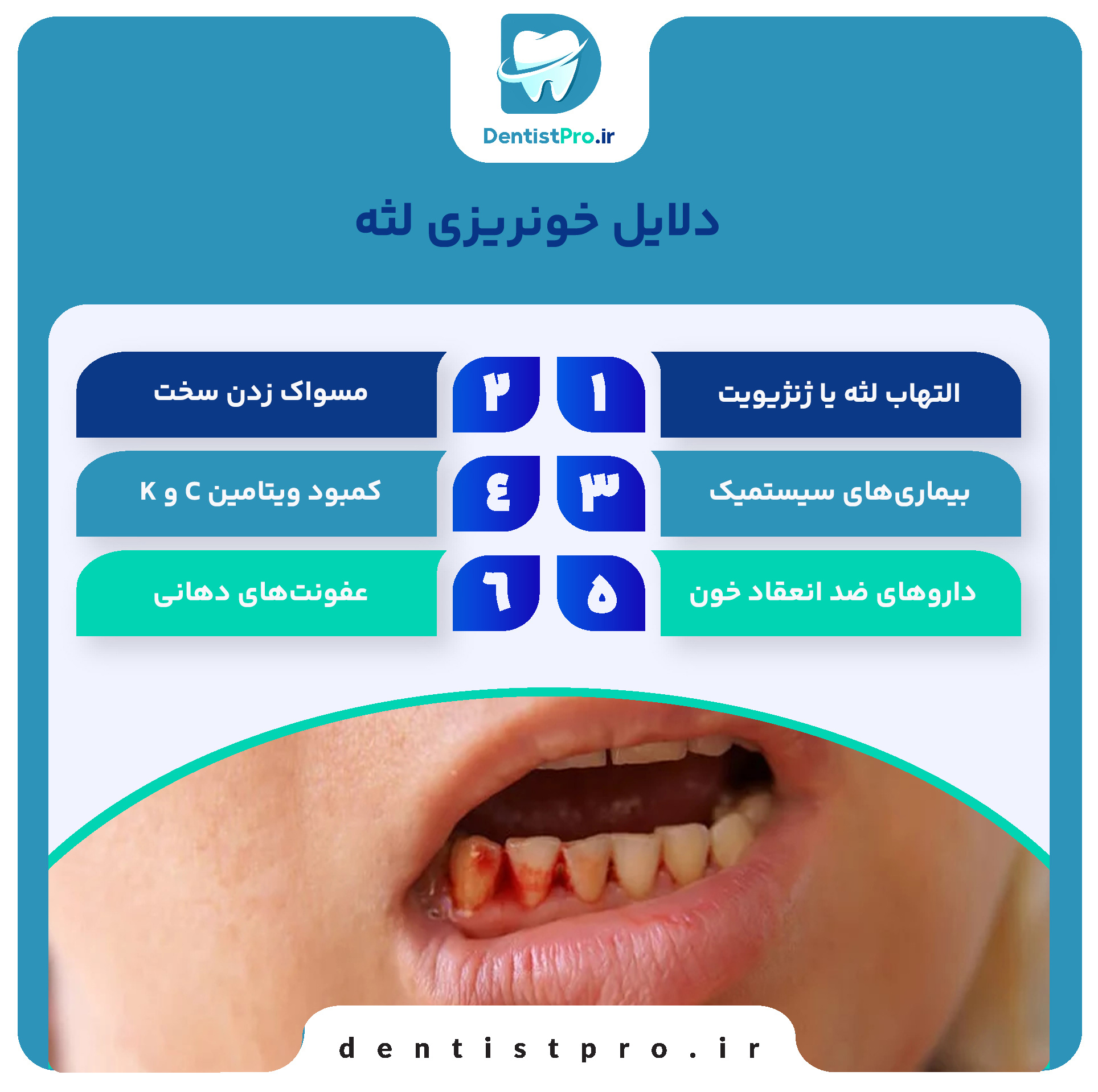 درمان خونریزی لثه در خانه+ موارد 100% حیاتی