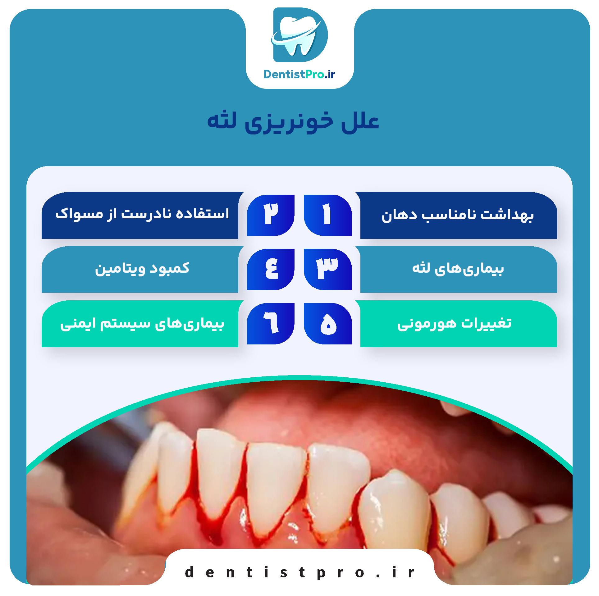 درمان خونریزی لثه در خانه؛ راهکارهایی ساده اما مؤثر 26 درمان خونریزی لثه در خانه؛ راهکارهایی ساده اما مؤثر
