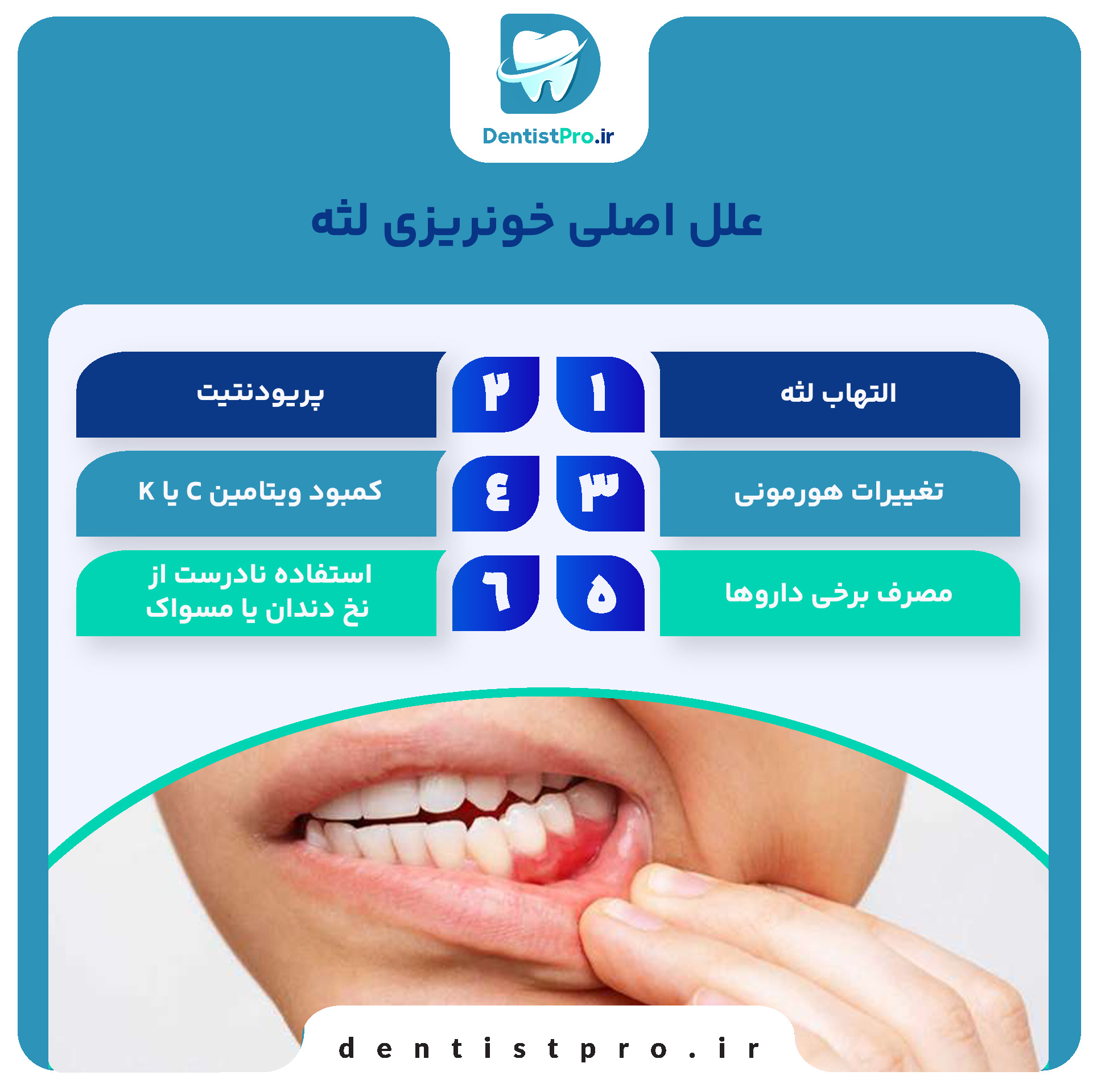 درمان خونریزی مکرر لثه ها چیست؟ 27 درمان خونریزی مکرر لثه ها چیست؟