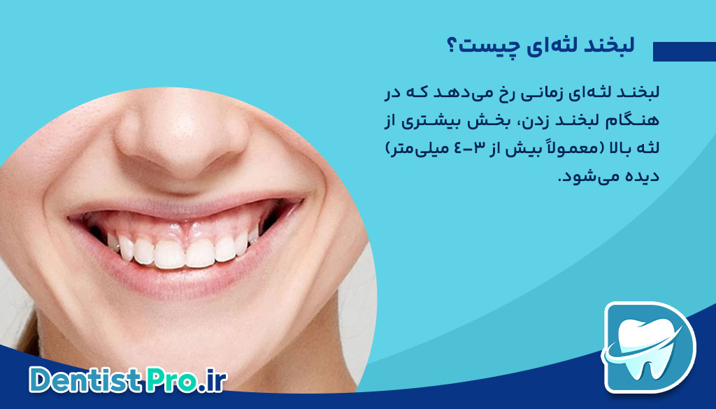 درمان لبخند لثه ای+0 تا 100 موارد مهم 26 درمان لبخند لثه ای+0 تا 100 موارد مهم