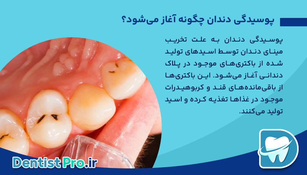 درمان پوسیدگی دندان در مراحل اولیه: پیشگیری بهتر از درمان