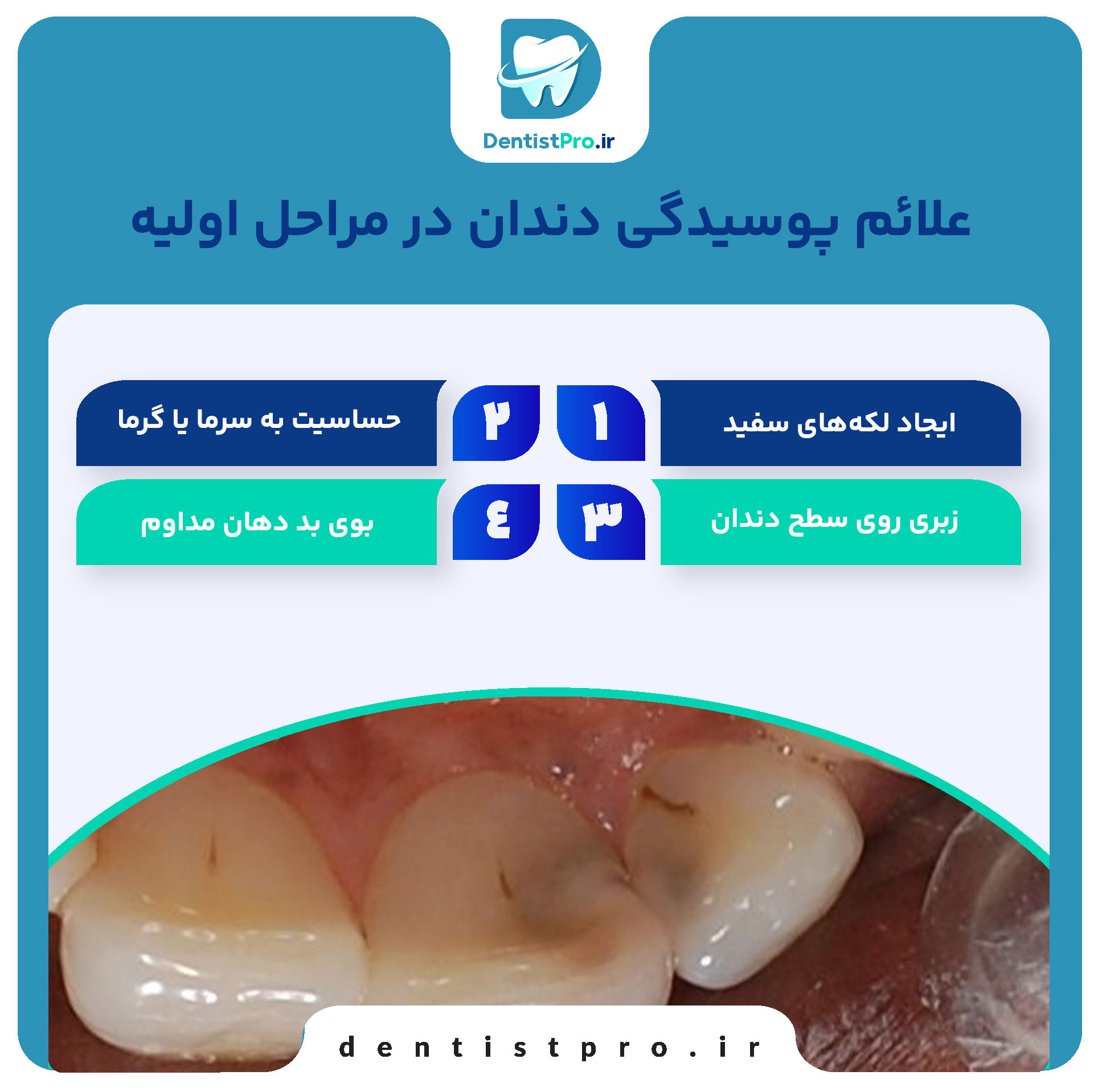 درمان پوسیدگی دندان در مراحل اولیه: پیشگیری بهتر از درمان