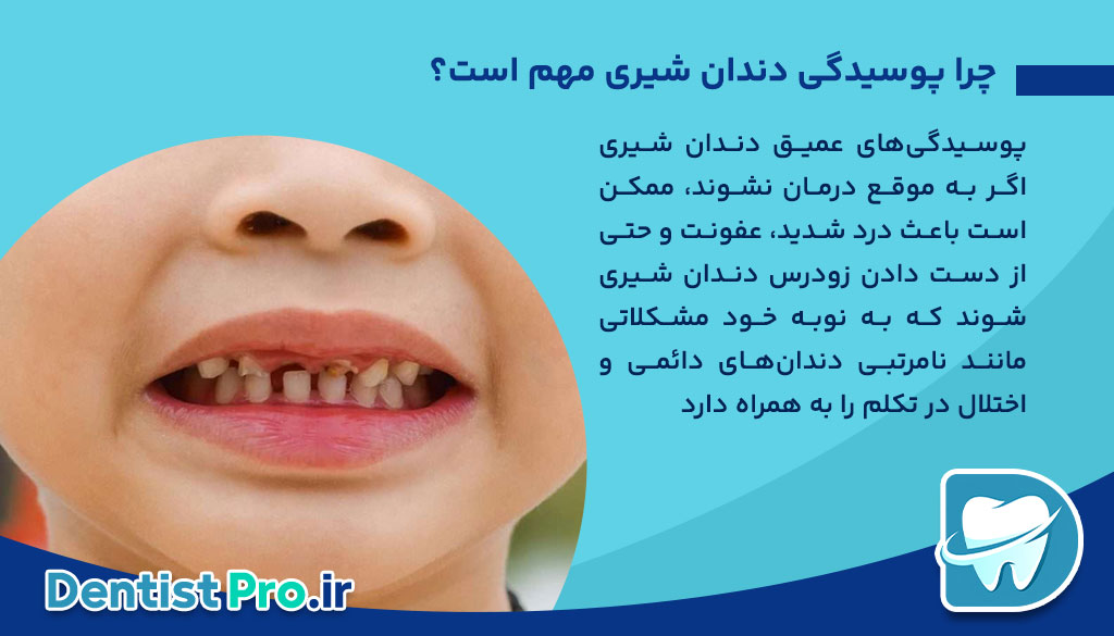 درمان پوسیدگی عمیق دندان شیری: راهکارها، روش‌ها و مراقبت‌ها