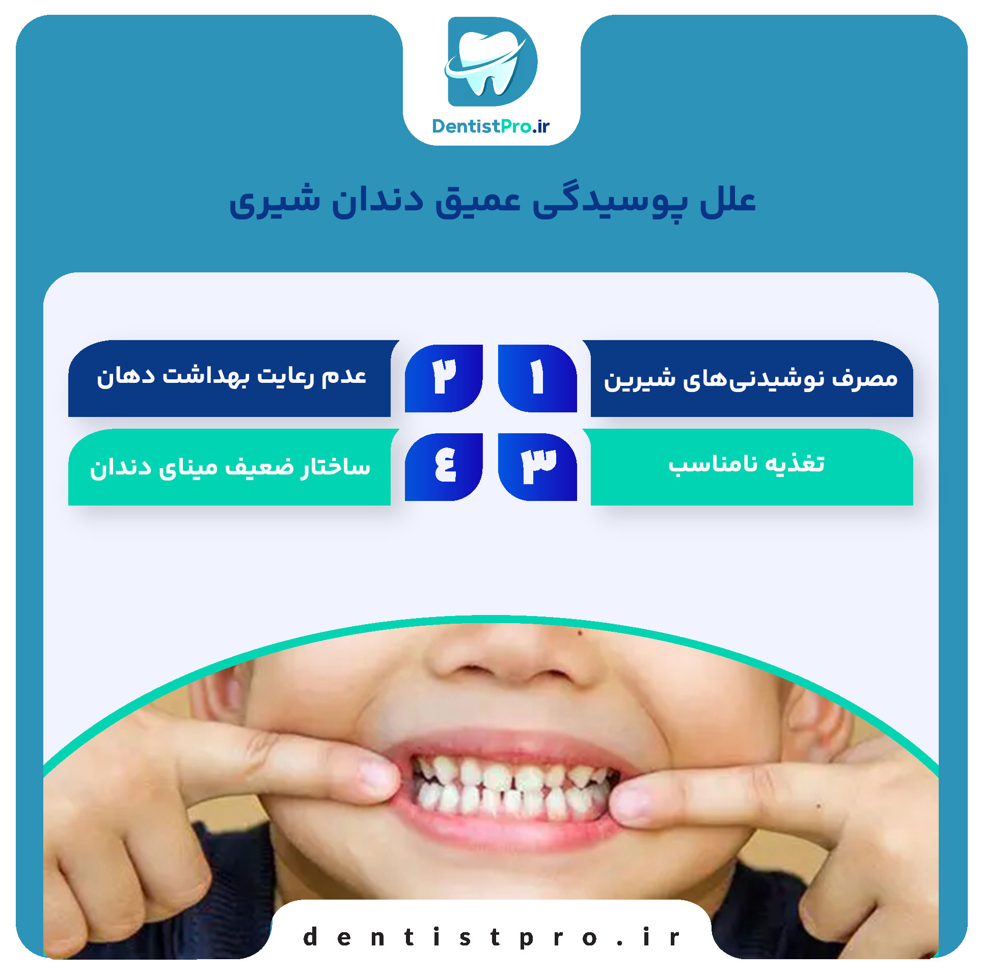 درمان پوسیدگی عمیق دندان شیری: راهکارها، روش‌ها و مراقبت‌ها