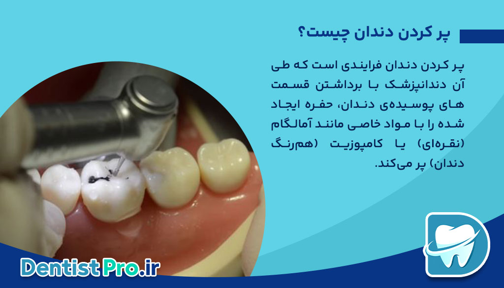 دندان درد بعد از پر کردن دندان+ مواردی که باید بدانید 26 دندان درد بعد از پر کردن دندان+ مواردی که باید بدانید