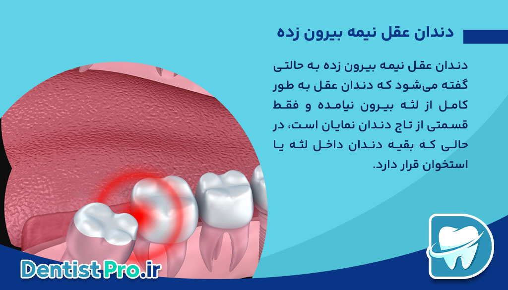 دندان عقل نیمه بیرون زده؛ علل، مشکلات، روشهای درمان و نکات مهم 26 دندان عقل نیمه بیرون زده؛ علل، مشکلات، روشهای درمان و نکات مهم