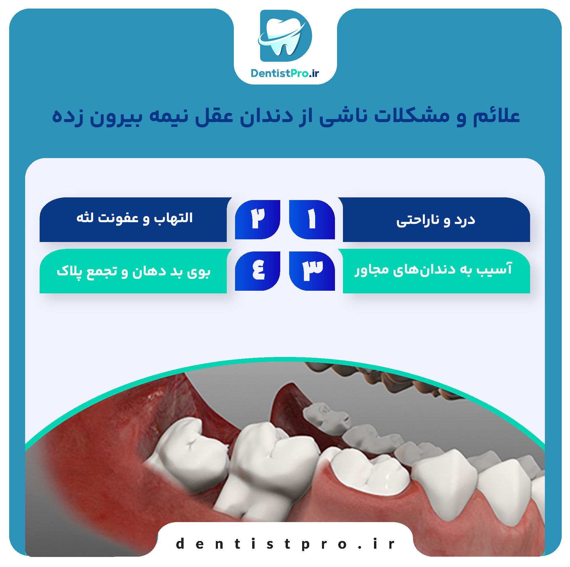 دندان عقل نیمه بیرون زده؛ علل، مشکلات، روشهای درمان و نکات مهم 28 دندان عقل نیمه بیرون زده؛ علل، مشکلات، روشهای درمان و نکات مهم