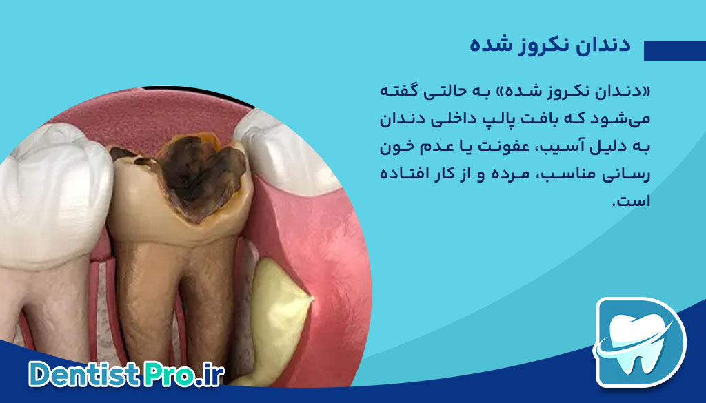 دندان نکروز شده: علل، علائم و درمانهای موثر 26 دندان نکروز شده: علل، علائم و درمانهای موثر