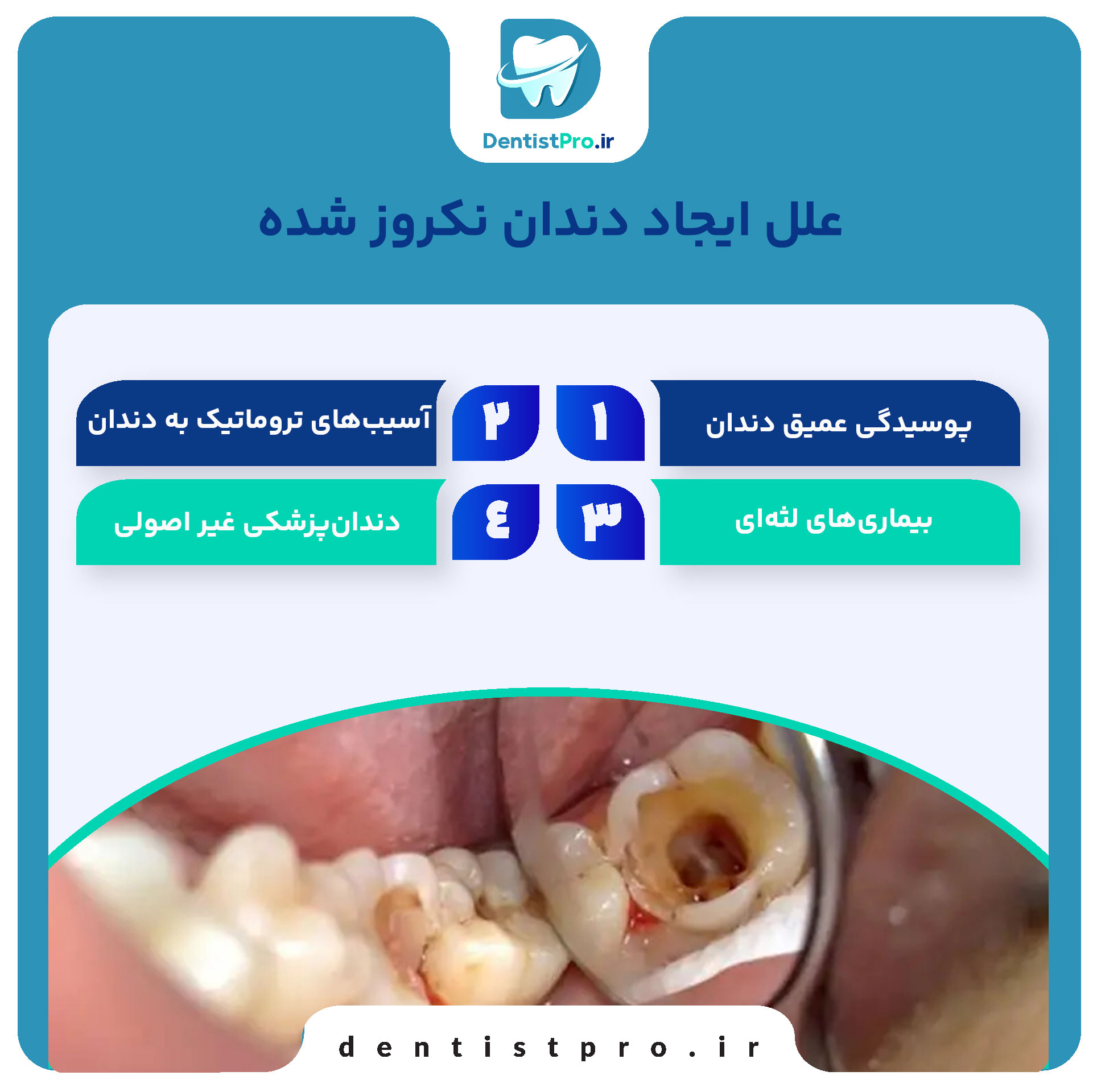 دندان نکروز شده: علل، علائم و درمانهای موثر 28 دندان نکروز شده: علل، علائم و درمانهای موثر