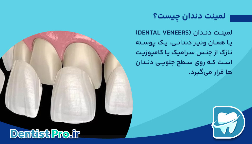 راهنمای کامل لمینت دندان برای مبتدی ها 26 راهنمای کامل لمینت دندان برای مبتدی ها