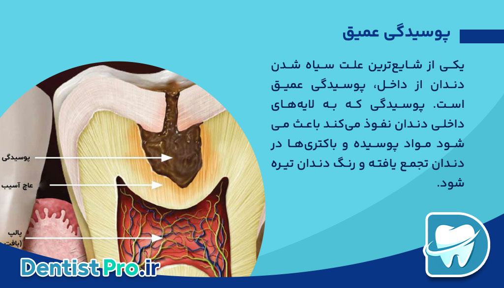 علت سیاه شدن دندان از داخل