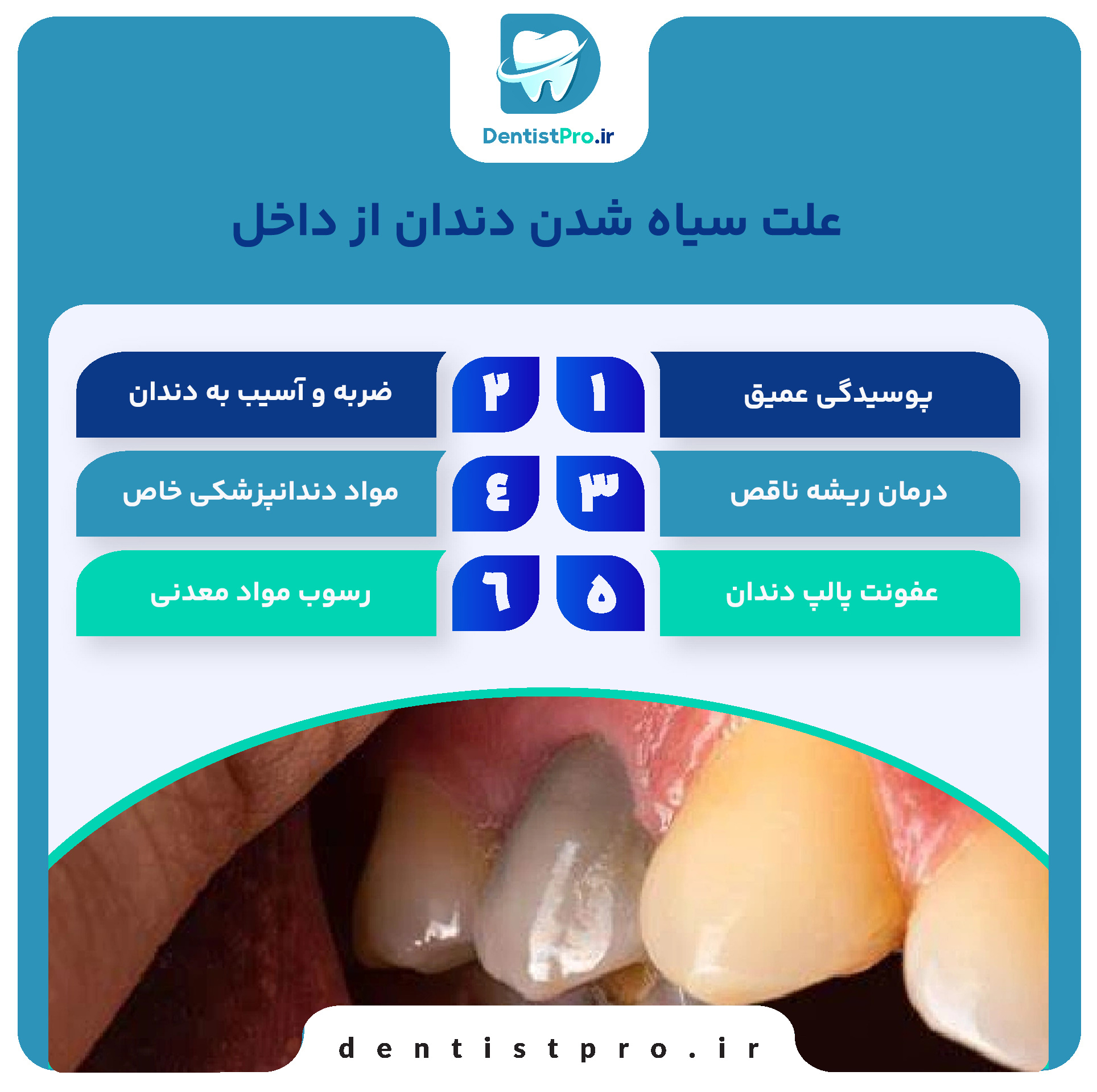 علت سیاه شدن دندان از داخل