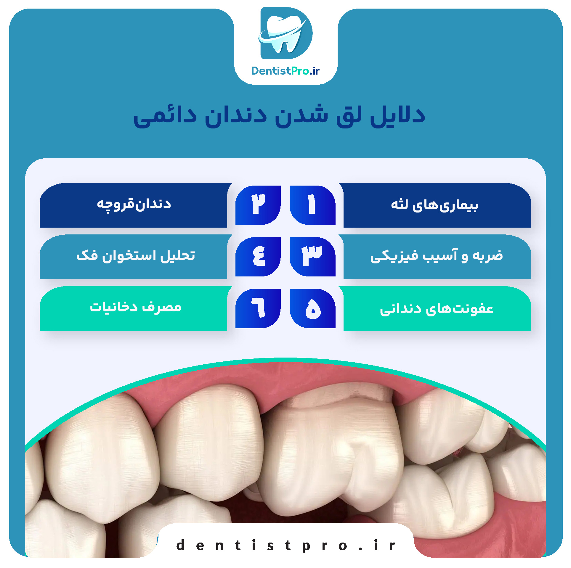 علت لق شدن دندان دائمی در بزرگسالان+0 تا 100 مطالب مهم
