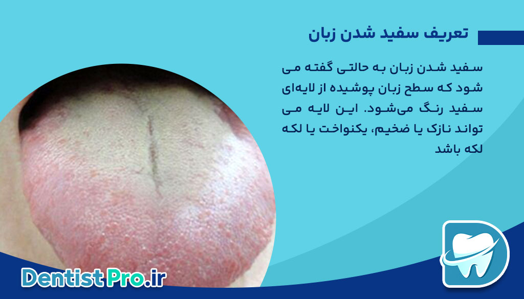 علل سفید شدن زبان چیست؟ 26 علل سفید شدن زبان چیست؟