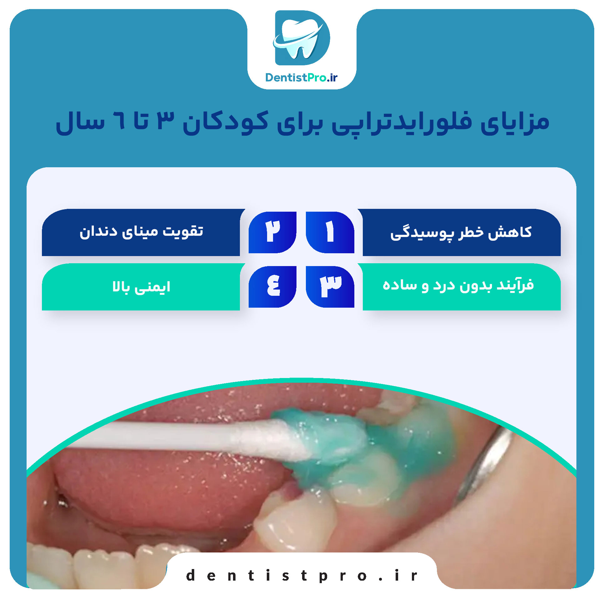 فلورایدتراپی برای کودکان ۳ تا ۶ سال: راهکاری موثر برای پیشگیری از پوسیدگی دندان