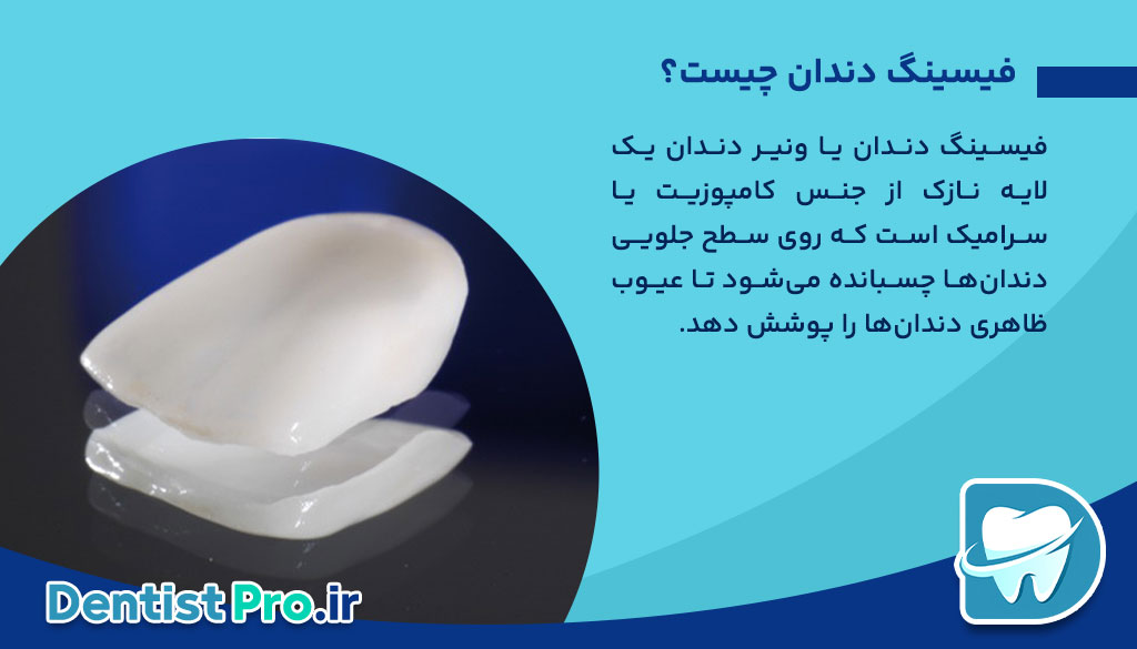 فیسینگ دندان برای لبخند بازیگران؛ راز زیبایی بینقص و اعتماد به نفس 26 فیسینگ دندان برای لبخند بازیگران؛ راز زیبایی بینقص و اعتماد به نفس