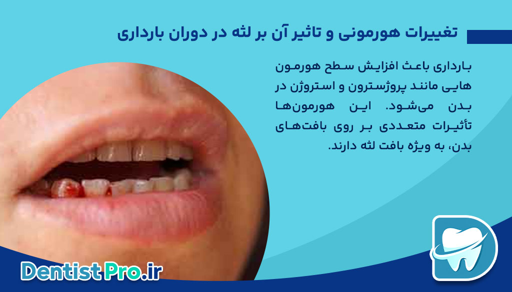 لثه در دوران بارداری: مراقبتها، مشکلات و راهکارهای حفظ سلامت 26 لثه در دوران بارداری: مراقبتها، مشکلات و راهکارهای حفظ سلامت