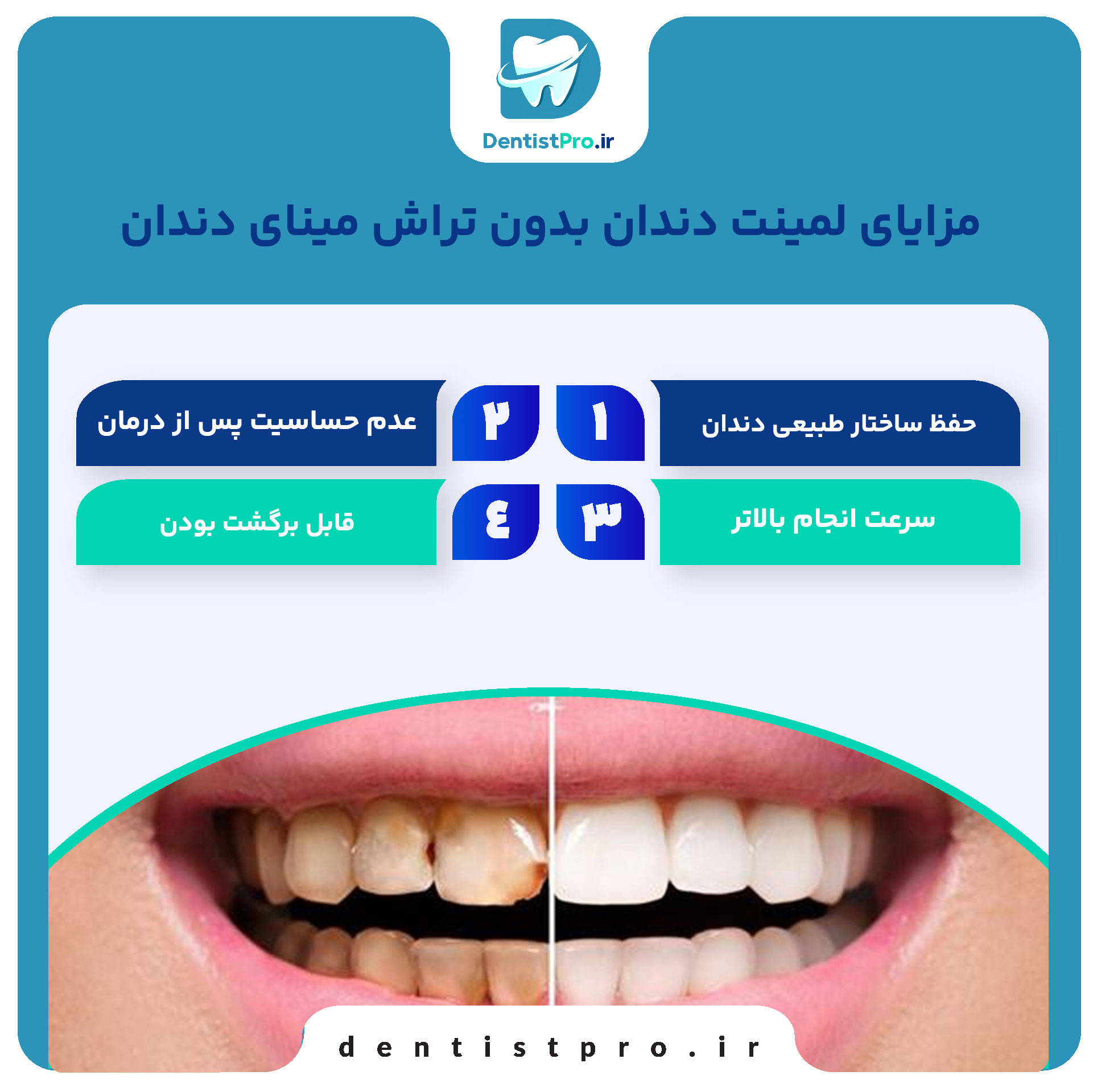 لمینت دندان بدون تراش مینای دندان: راهکاری نوین برای زیبایی لبخند