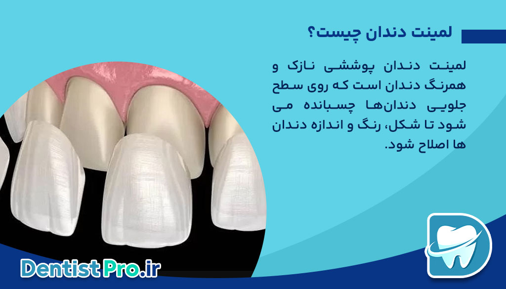 لمینت دندان برای دندان های فاصله دار: راهنمای جامع و کامل