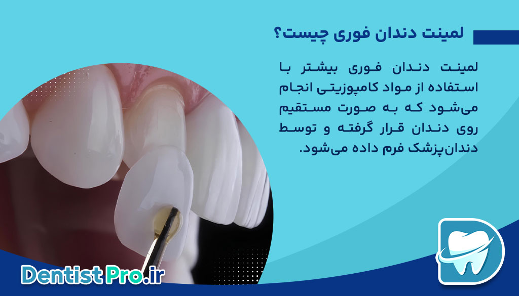 لمینت دندان فوری؛ راهی سریع برای داشتن لبخندی جذاب 26 لمینت دندان فوری؛ راهی سریع برای داشتن لبخندی جذاب