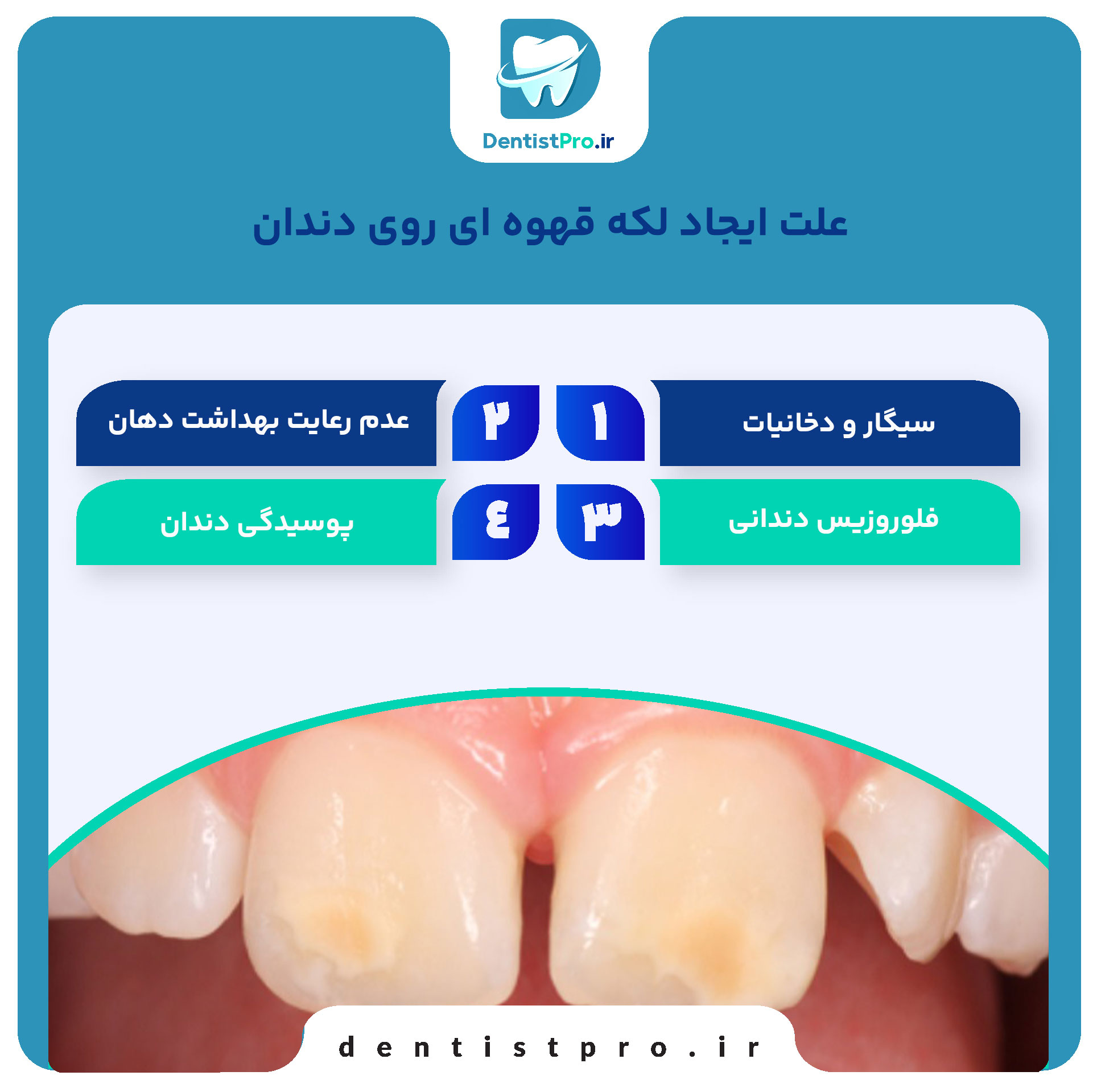 لکه قهوه ای روی دندان+ 0 تا 100 دلایل، پیشگیری و درمان