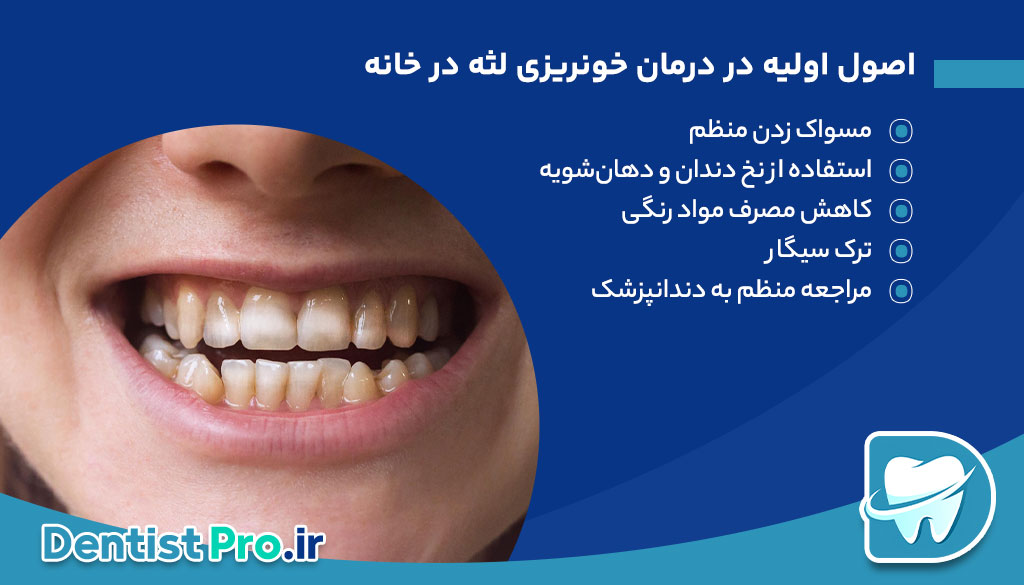 لکه قهوه ای روی دندان+ 0 تا 100 دلایل، پیشگیری و درمان