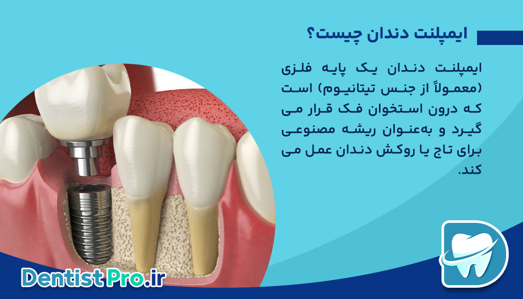 مقایسه ایمپلنت با دندان مصنوعی؛ راهنمای کامل انتخاب جایگزین دندان از دست‌رفته