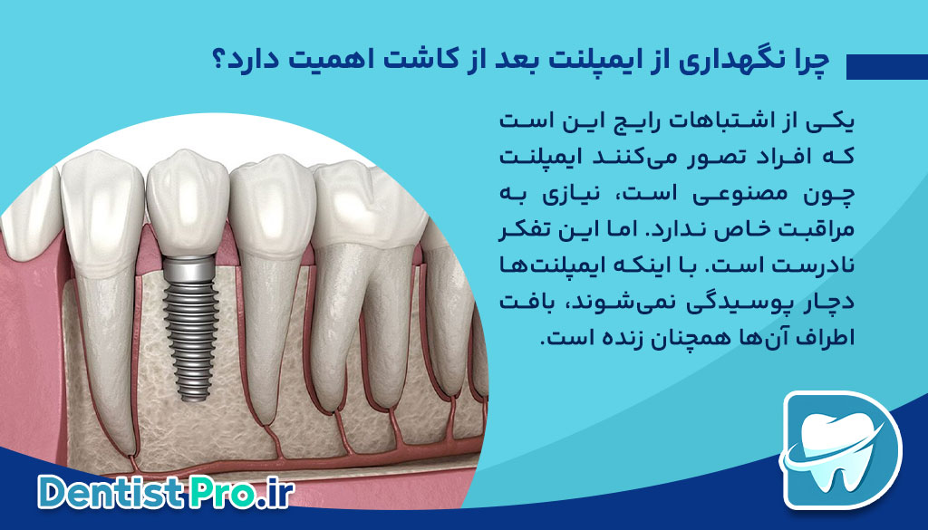 نگهداری از ایمپلنت بعد از کاشت+ موارد 100% حیاتی