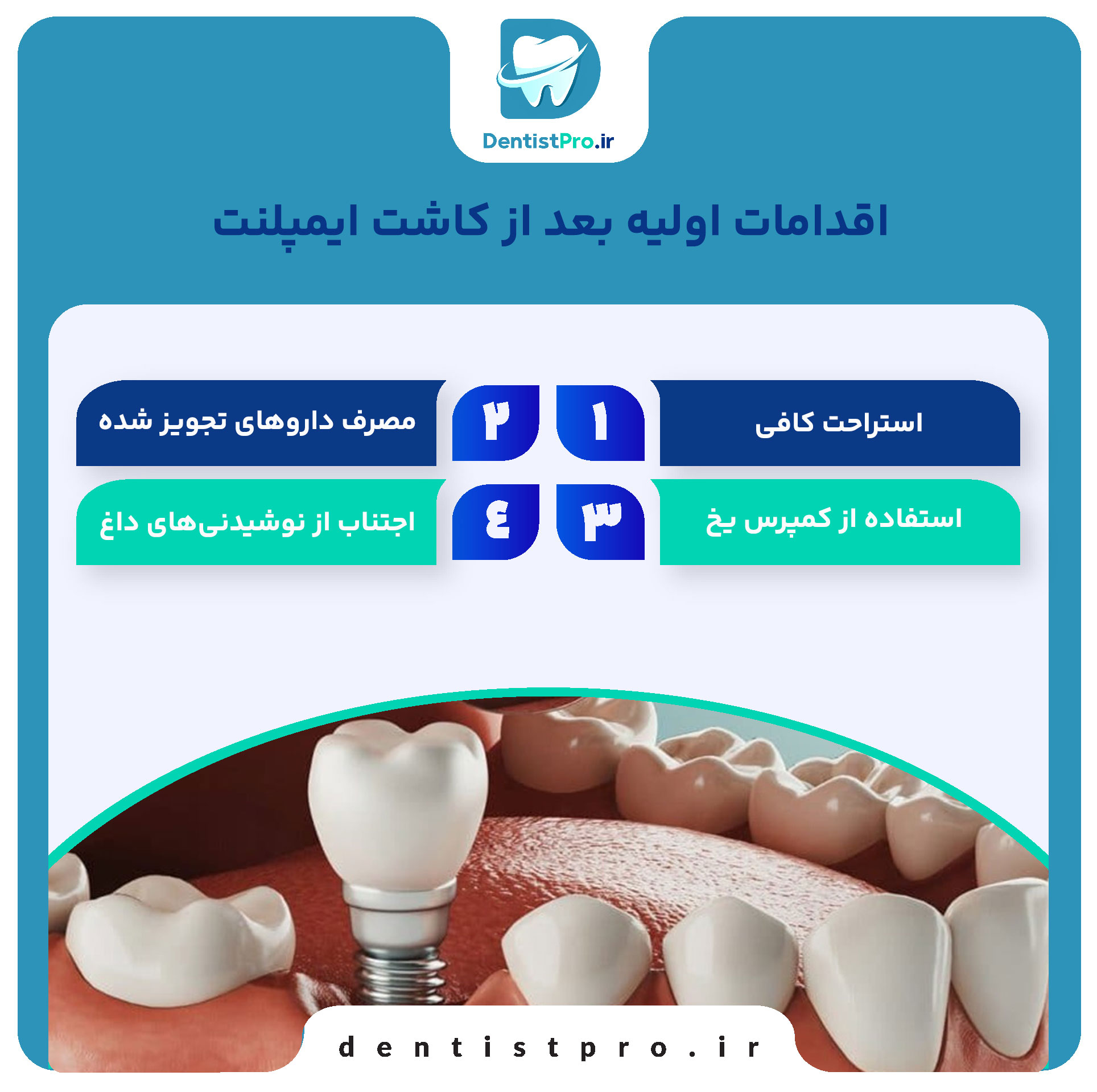 نگهداری از ایمپلنت بعد از کاشت+ موارد 100% حیاتی