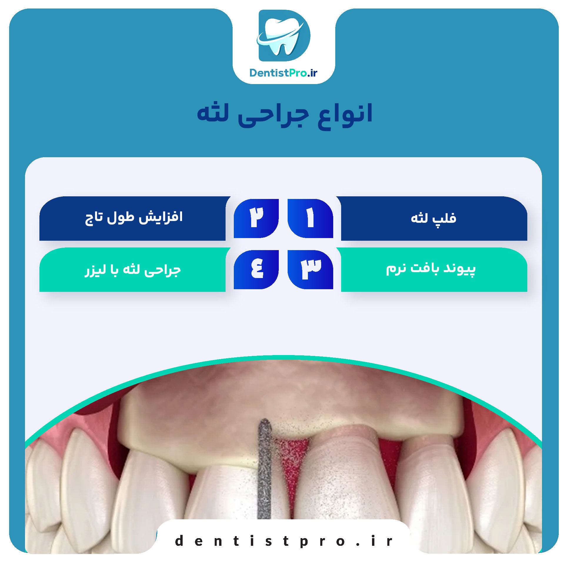 هزینه جراحی لثه؛ بررسی کامل تعرفهها و پارامترهای مؤثر 26 هزینه جراحی لثه؛ بررسی کامل تعرفهها و پارامترهای مؤثر