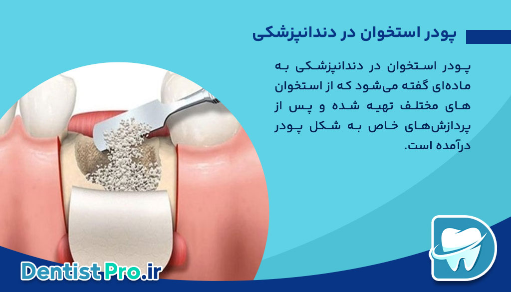 پودر استخوان در دندانپزشکی؛ کاربردها، انواع و مزایا