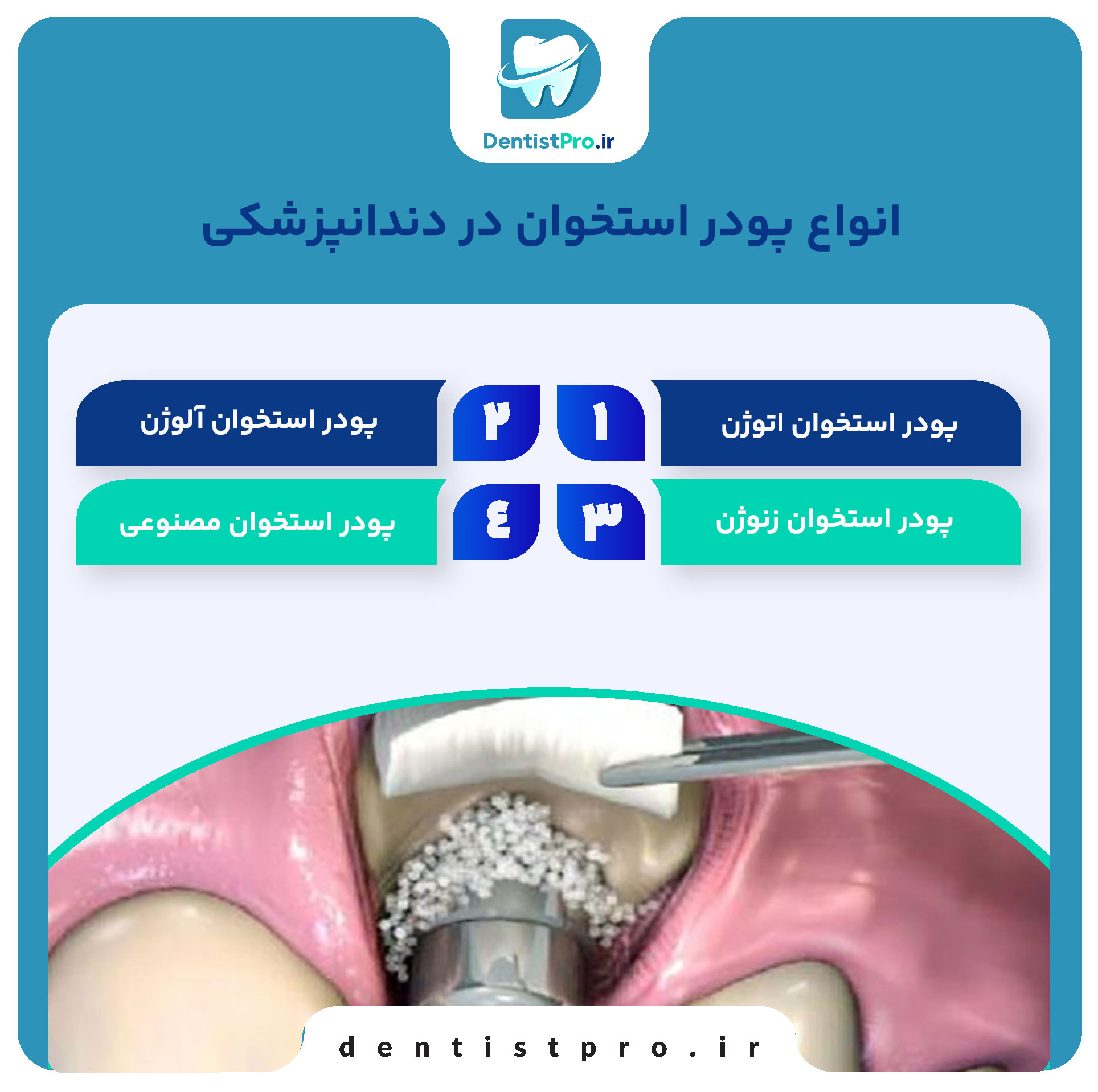 پودر استخوان در دندانپزشکی؛ کاربردها، انواع و مزایا