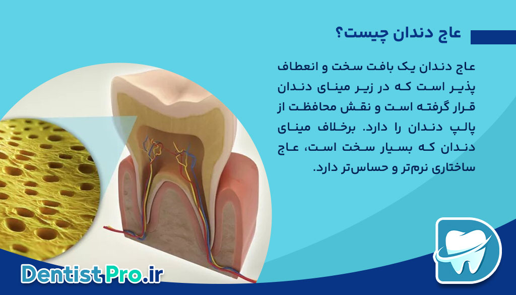 پوسیدگی عاج دندان؛ بررسی علل، علائم و روش‌های درمانی