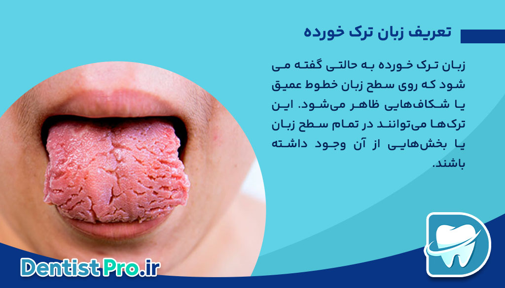 چرا زبان ترک خورده می شود؟