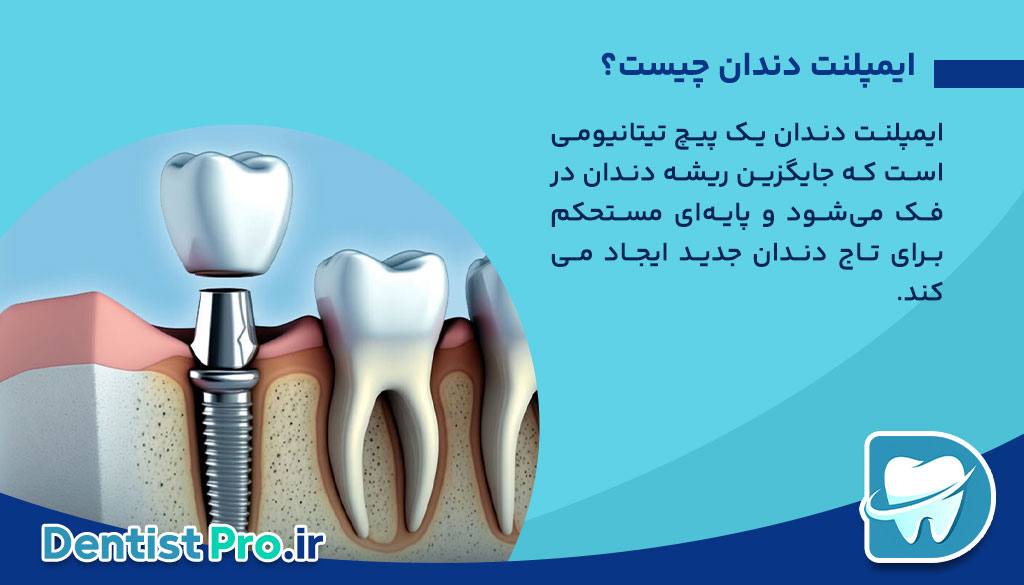کاشت ایمپلنت فوری با اسکن دیجیتال: انقلابی در دنیای دندان‌پزشکی