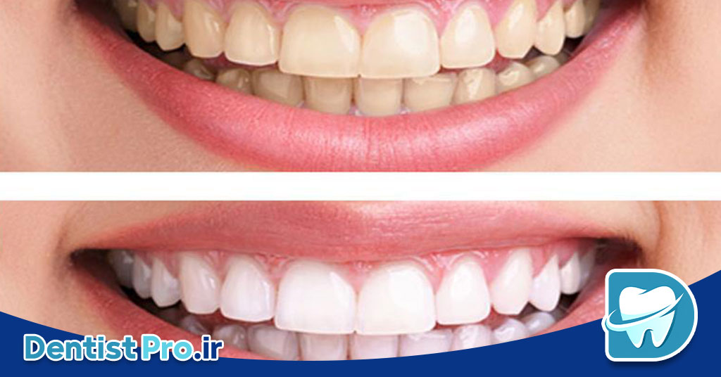 قبل و بعد از اصلاح لبخند