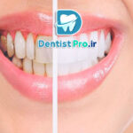 قبل و بعد از اصلاح لبخند