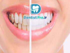 قبل و بعد از اصلاح لبخند 57 قبل و بعد از اصلاح لبخند