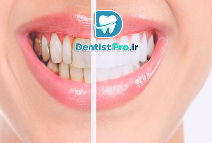 قبل و بعد از اصلاح لبخند