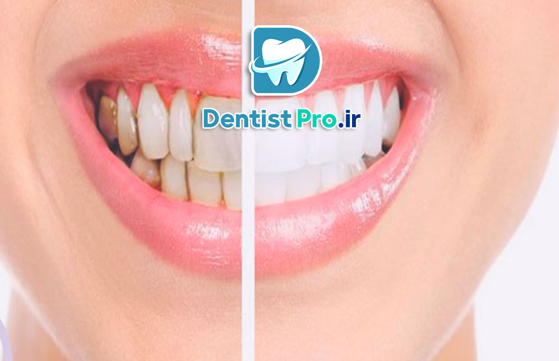 قبل و بعد از اصلاح لبخند