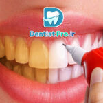 هزینه سفید کردن دندان در مطب دندانپزشکی